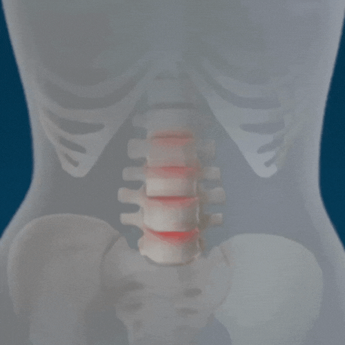 NeoCompress™ Heup Brace